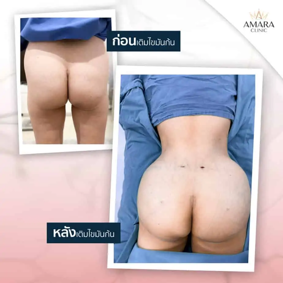 ดูดไขมัน เติมไขมัน Amara Liposuction Center (เอมาร่า คลินิก) โดยแพทย์ผู้มีประสบการณ์