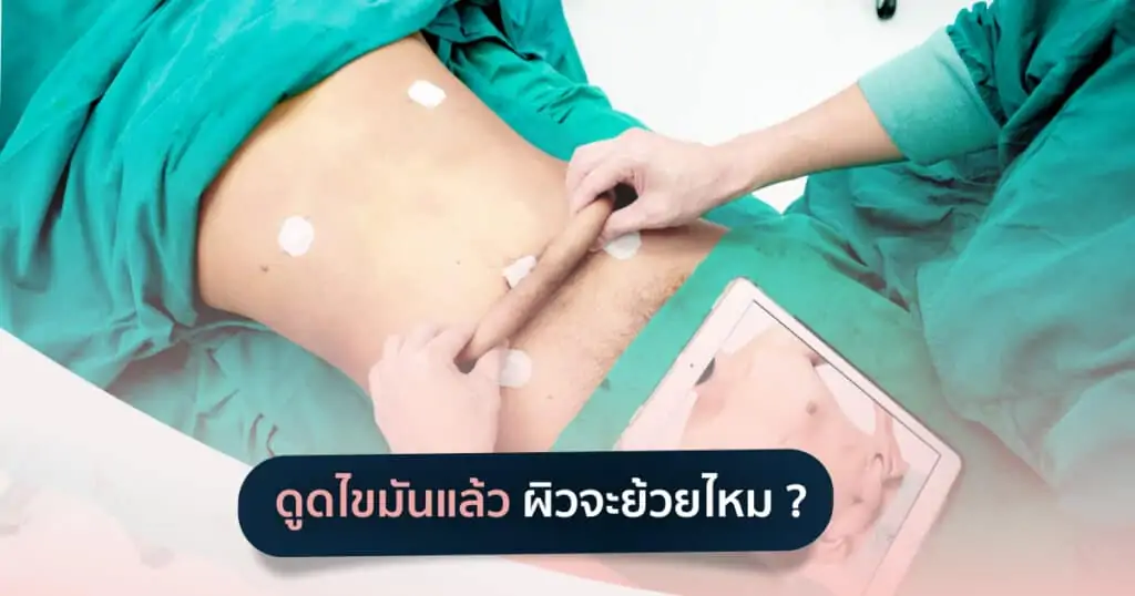 ดูดไขมัน เติมไขมัน Amara Liposuction Center (เอมาร่า คลินิก) โดยแพทย์ผู้มีประสบการณ์