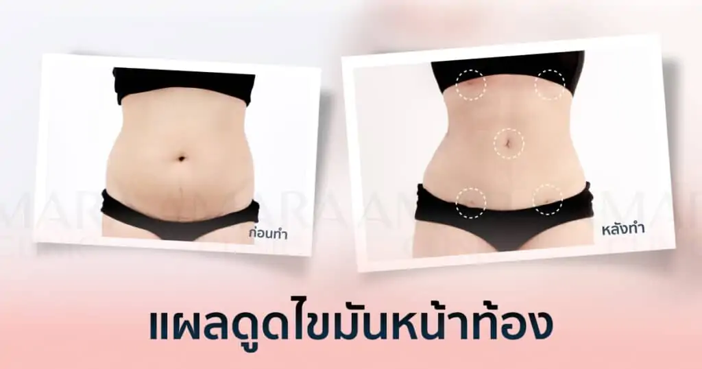 ดูดไขมัน เติมไขมัน Amara Liposuction Center (เอมาร่า คลินิก) โดยแพทย์ผู้มีประสบการณ์