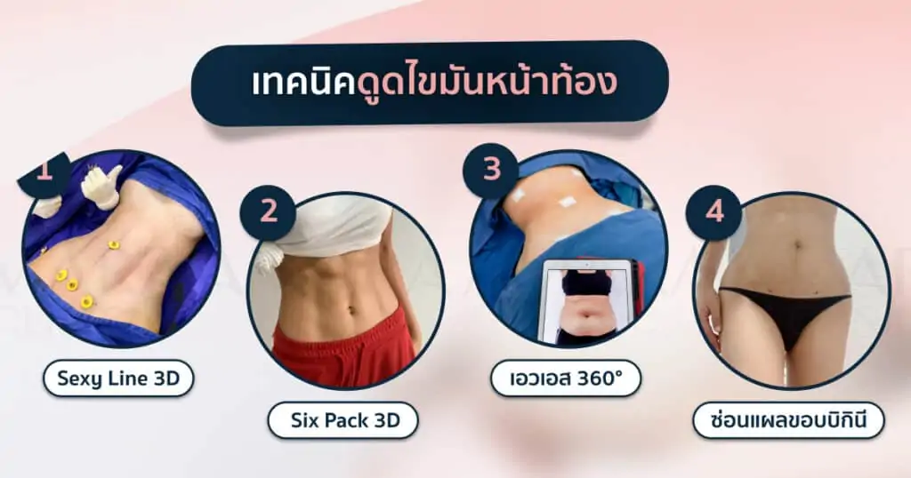 ดูดไขมัน เติมไขมัน Amara Liposuction Center (เอมาร่า คลินิก) โดยแพทย์ผู้มีประสบการณ์
