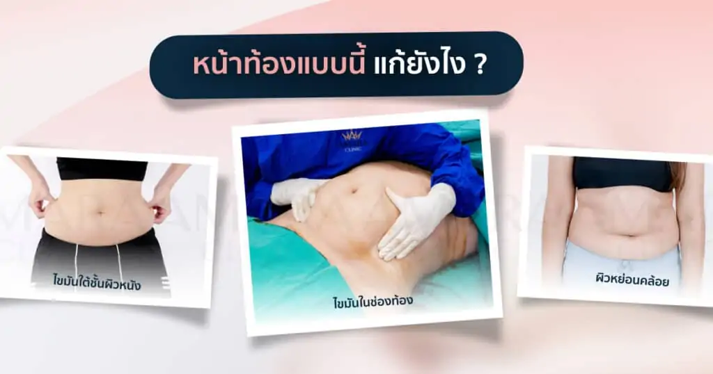 ดูดไขมัน เติมไขมัน Amara Liposuction Center (เอมาร่า คลินิก) โดยแพทย์ผู้มีประสบการณ์