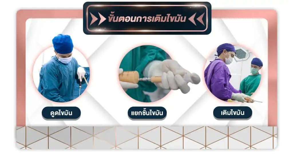 ขั้นตอนการเติมไขมัน