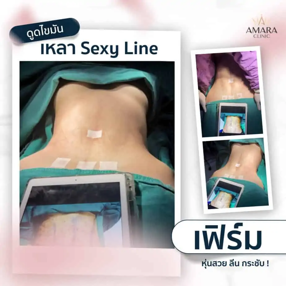 ดูดไขมัน เติมไขมัน Amara Liposuction Center (เอมาร่า คลินิก) โดยแพทย์ผู้มีประสบการณ์