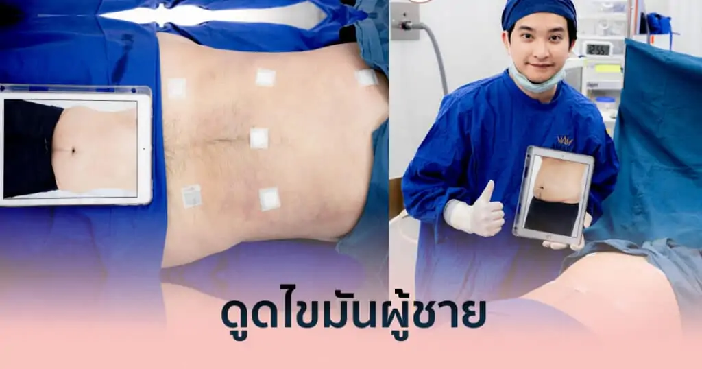 ดูดไขมัน เติมไขมัน Amara Liposuction Center (เอมาร่า คลินิก) โดยแพทย์ผู้มีประสบการณ์
