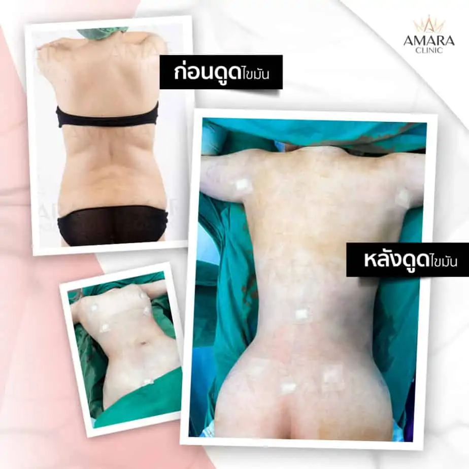 ดูดไขมัน เติมไขมัน Amara Liposuction Center (เอมาร่า คลินิก) โดยแพทย์ผู้มีประสบการณ์