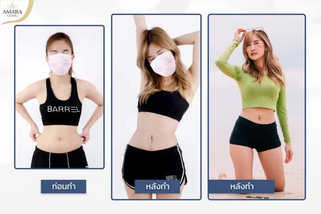 ดูดไขมัน เติมไขมัน Amara Liposuction Center (เอมาร่า คลินิก) โดยแพทย์ผู้มีประสบการณ์