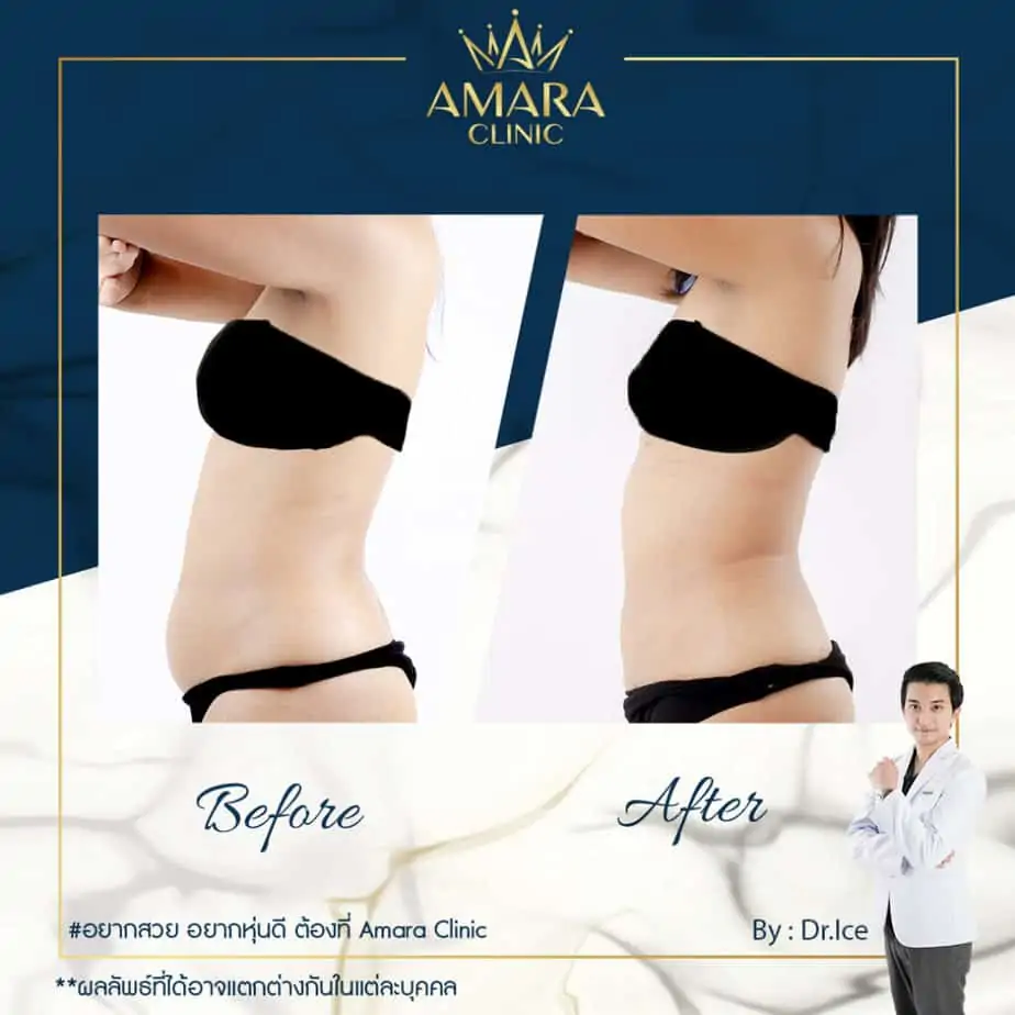 ดูดไขมัน เติมไขมัน Amara Liposuction Center (เอมาร่า คลินิก) โดยแพทย์ผู้มีประสบการณ์