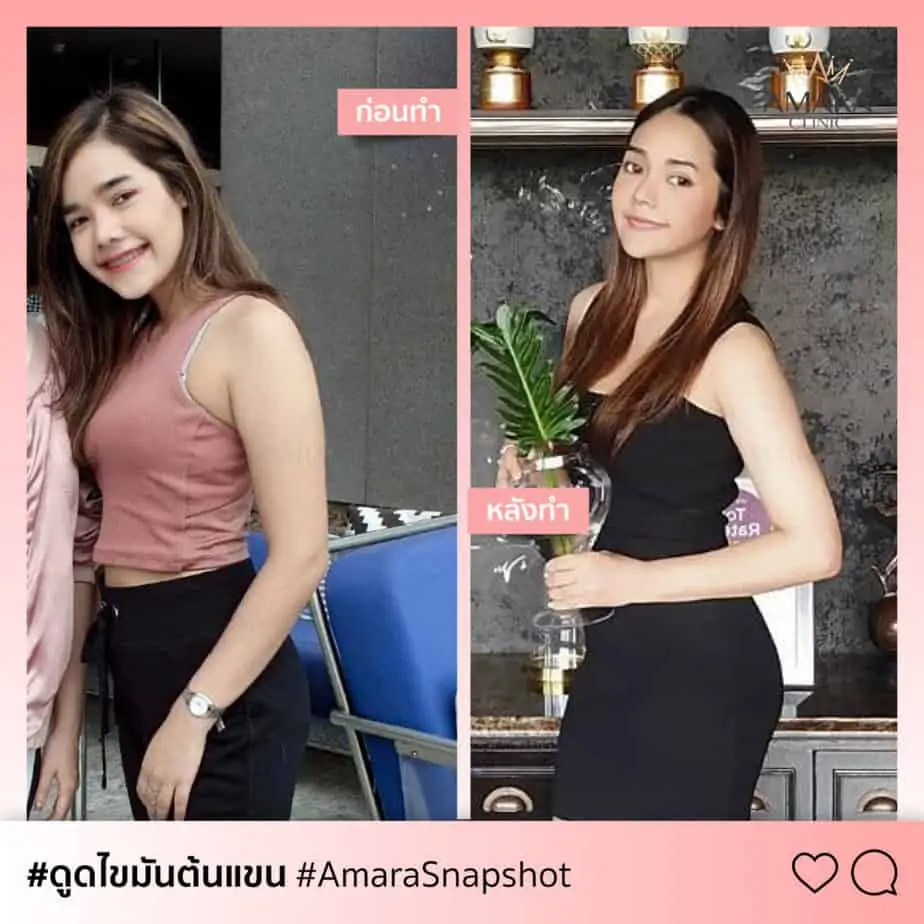 ดูดไขมัน เติมไขมัน Amara Liposuction Center (เอมาร่า คลินิก) โดยแพทย์ผู้มีประสบการณ์