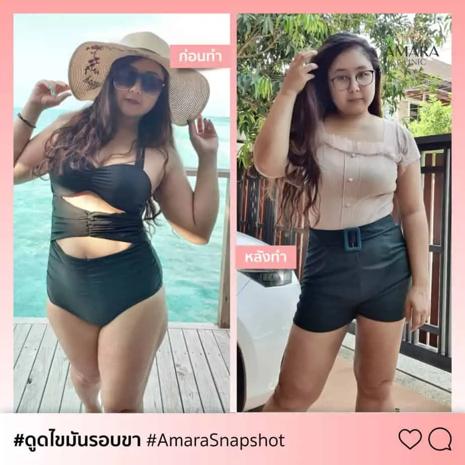 ดูดไขมัน เติมไขมัน Amara Liposuction Center (เอมาร่า คลินิก) โดยแพทย์ผู้มีประสบการณ์