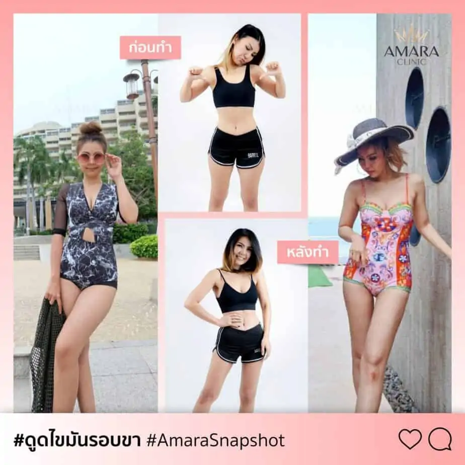 ดูดไขมัน เติมไขมัน Amara Liposuction Center (เอมาร่า คลินิก) โดยแพทย์ผู้มีประสบการณ์