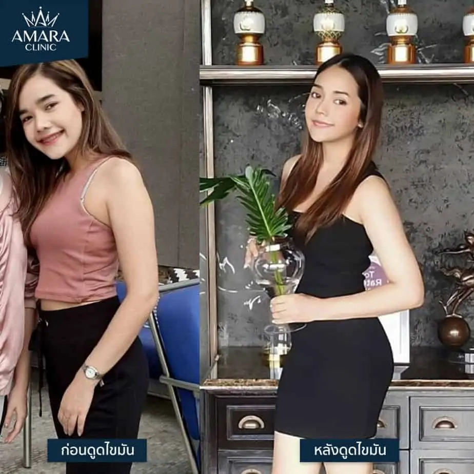 ดูดไขมัน เติมไขมัน Amara Liposuction Center (เอมาร่า คลินิก) โดยแพทย์ผู้มีประสบการณ์