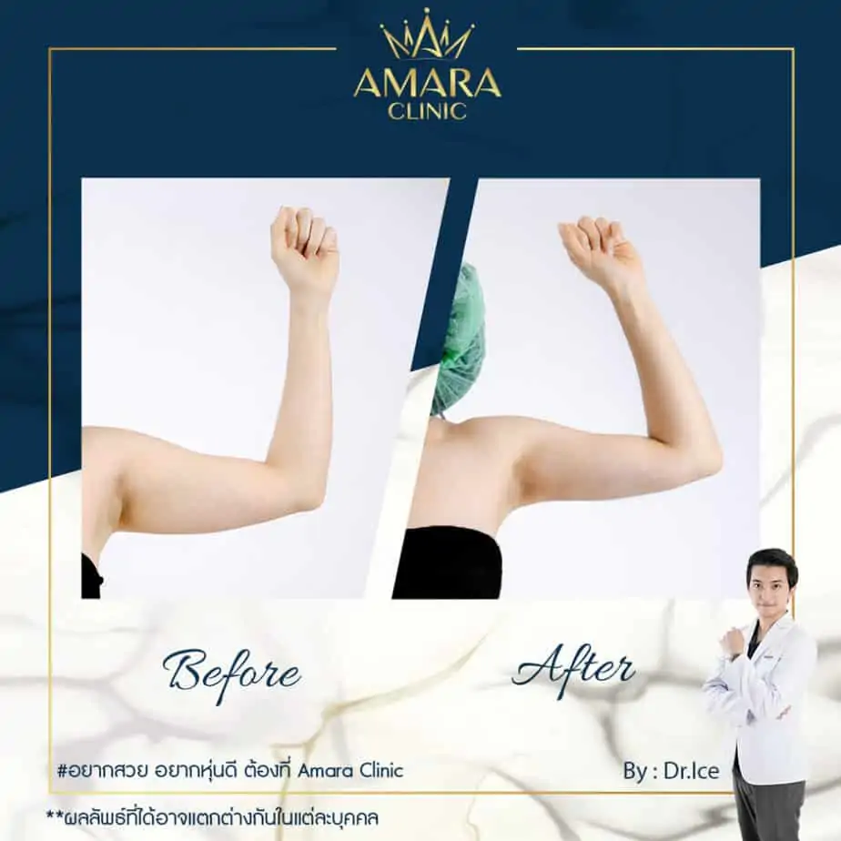 ดูดไขมัน เติมไขมัน Amara Liposuction Center (เอมาร่า คลินิก) โดยแพทย์ผู้มีประสบการณ์