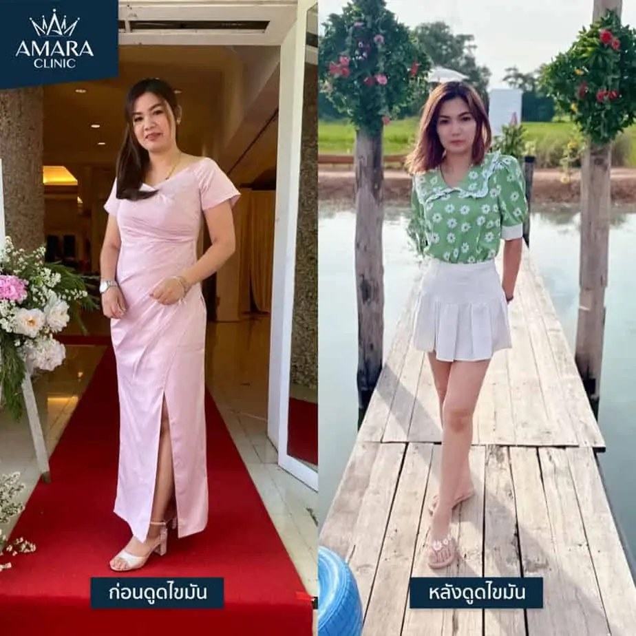 ดูดไขมัน เติมไขมัน Amara Liposuction Center (เอมาร่า คลินิก) โดยแพทย์ผู้มีประสบการณ์