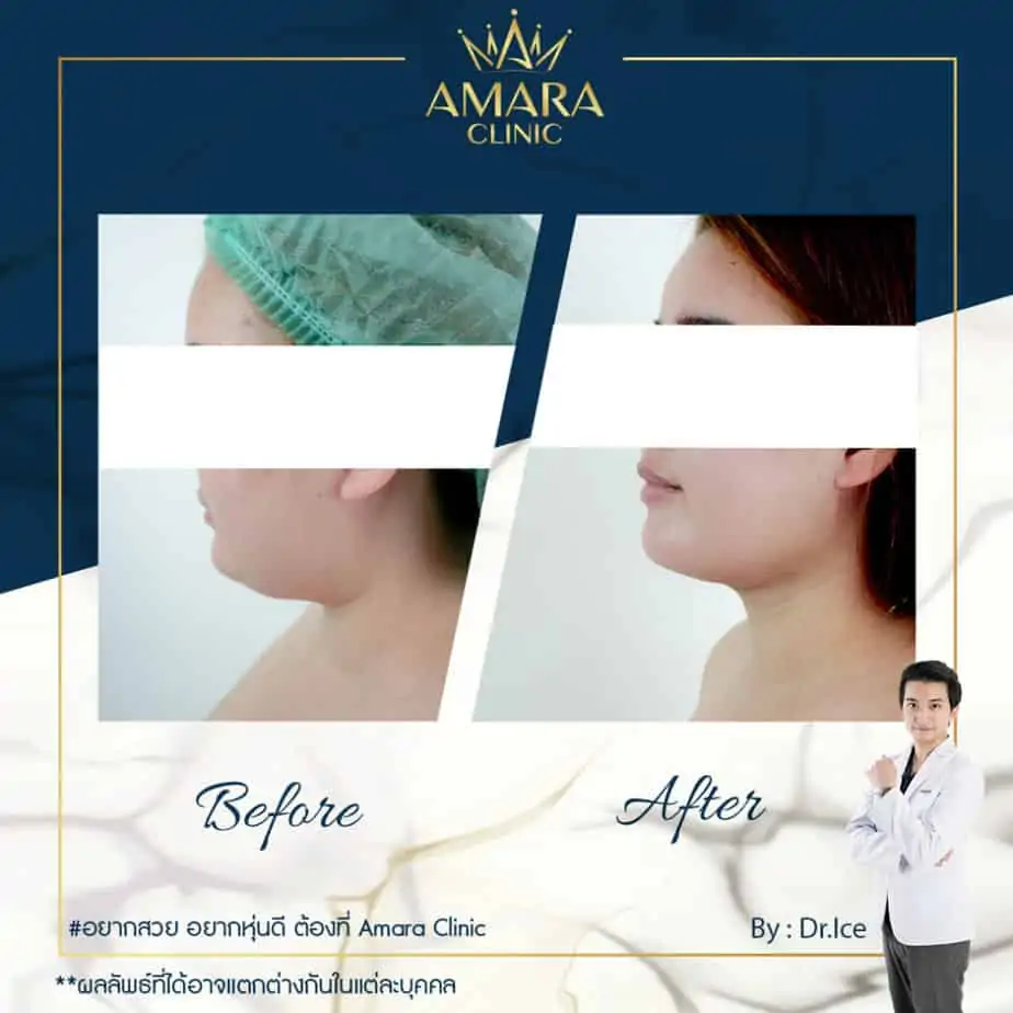 ดูดไขมัน เติมไขมัน Amara Liposuction Center (เอมาร่า คลินิก) โดยแพทย์ผู้มีประสบการณ์