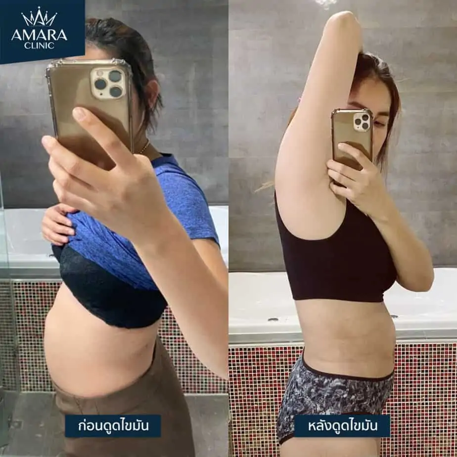 ดูดไขมัน เติมไขมัน Amara Liposuction Center (เอมาร่า คลินิก) โดยแพทย์ผู้มีประสบการณ์