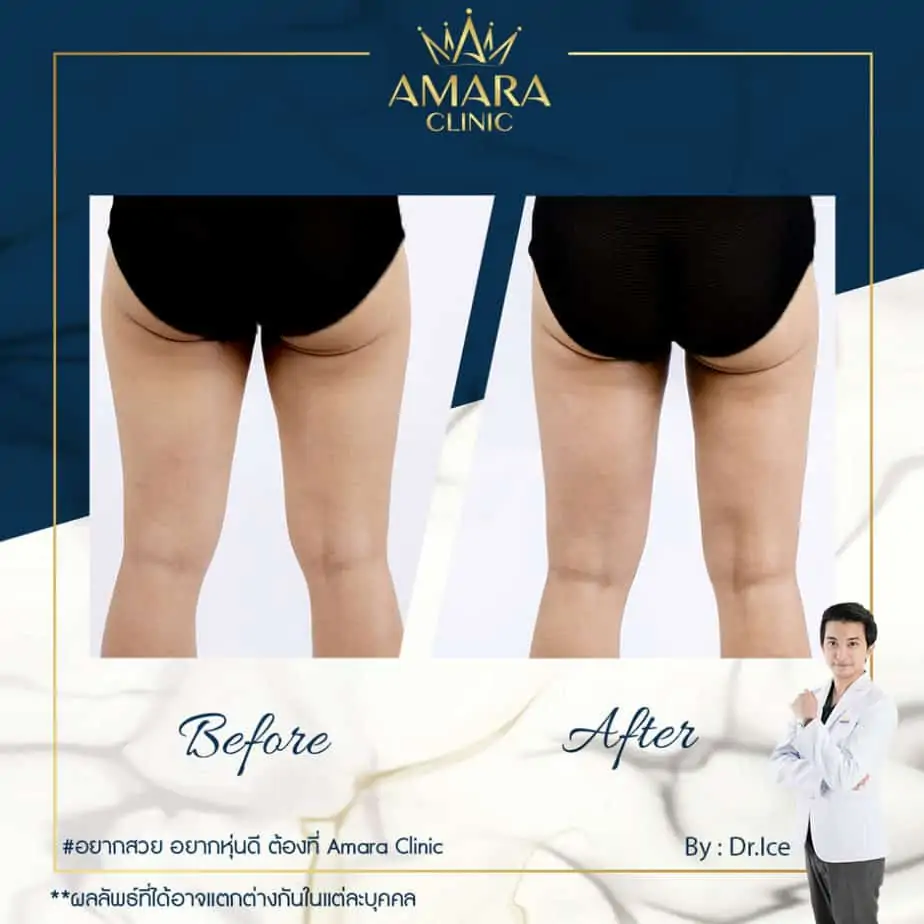 ดูดไขมัน เติมไขมัน Amara Liposuction Center (เอมาร่า คลินิก) โดยแพทย์ผู้มีประสบการณ์