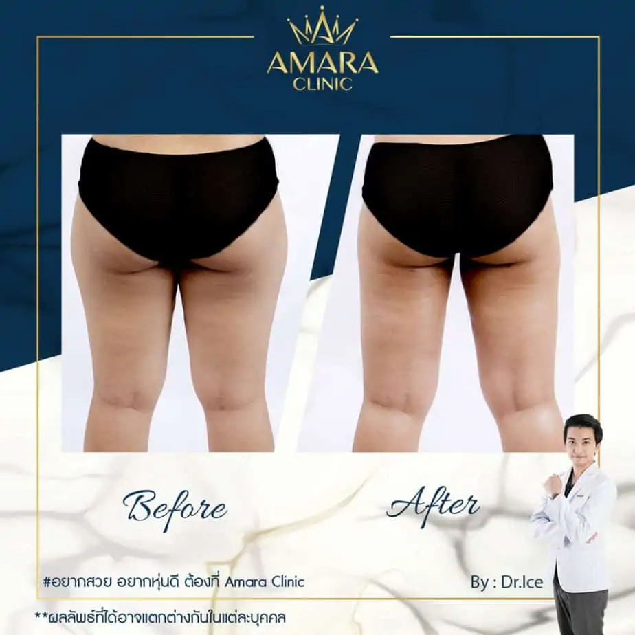 ดูดไขมัน เติมไขมัน Amara Liposuction Center (เอมาร่า คลินิก) โดยแพทย์ผู้มีประสบการณ์