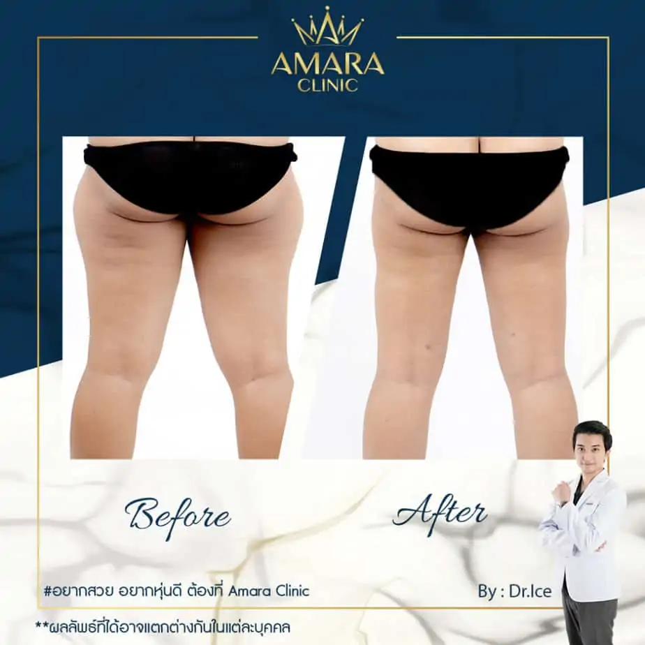 ดูดไขมัน เติมไขมัน Amara Liposuction Center (เอมาร่า คลินิก) โดยแพทย์ผู้มีประสบการณ์