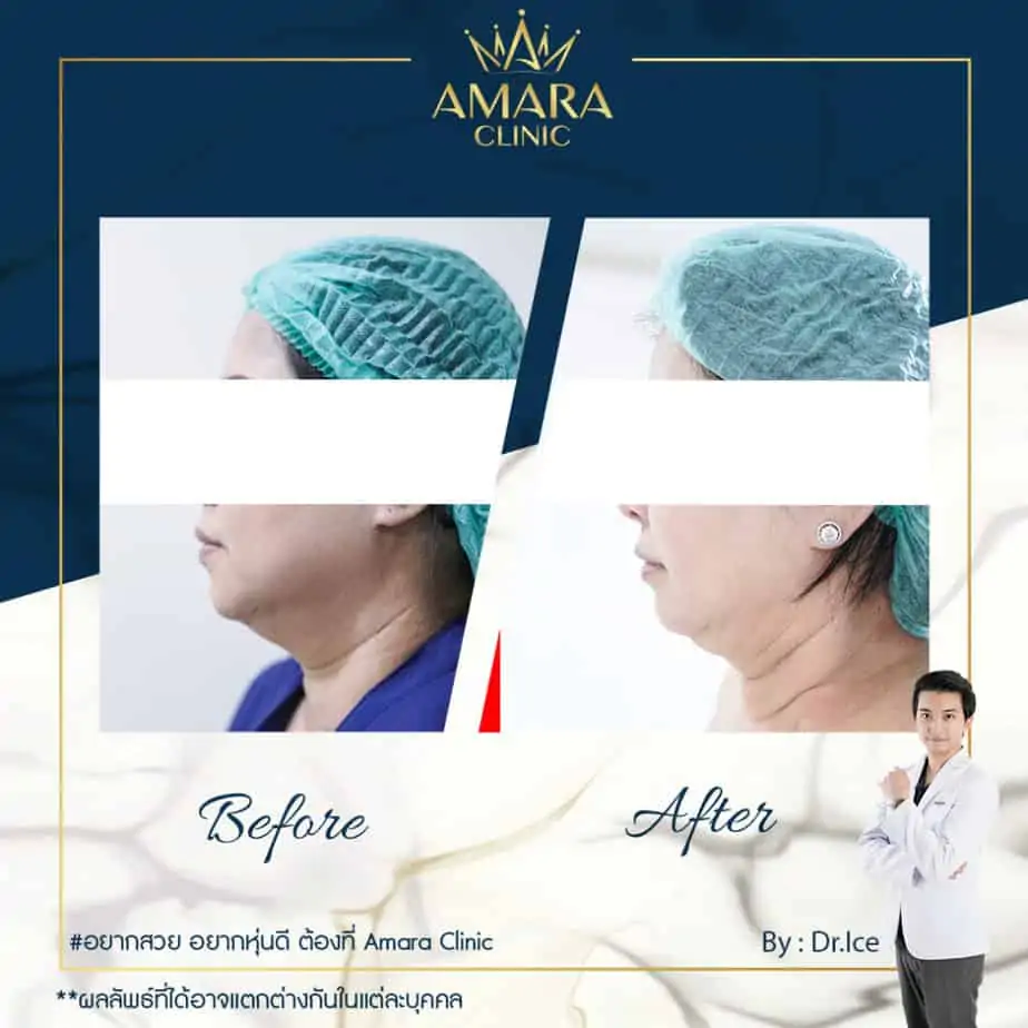 ดูดไขมัน เติมไขมัน Amara Liposuction Center (เอมาร่า คลินิก) โดยแพทย์ผู้มีประสบการณ์