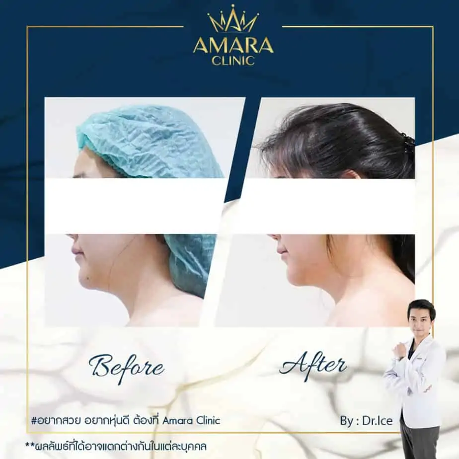 ดูดไขมัน เติมไขมัน Amara Liposuction Center (เอมาร่า คลินิก) โดยแพทย์ผู้มีประสบการณ์