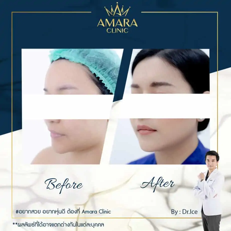 ดูดไขมัน เติมไขมัน Amara Liposuction Center (เอมาร่า คลินิก) โดยแพทย์ผู้มีประสบการณ์