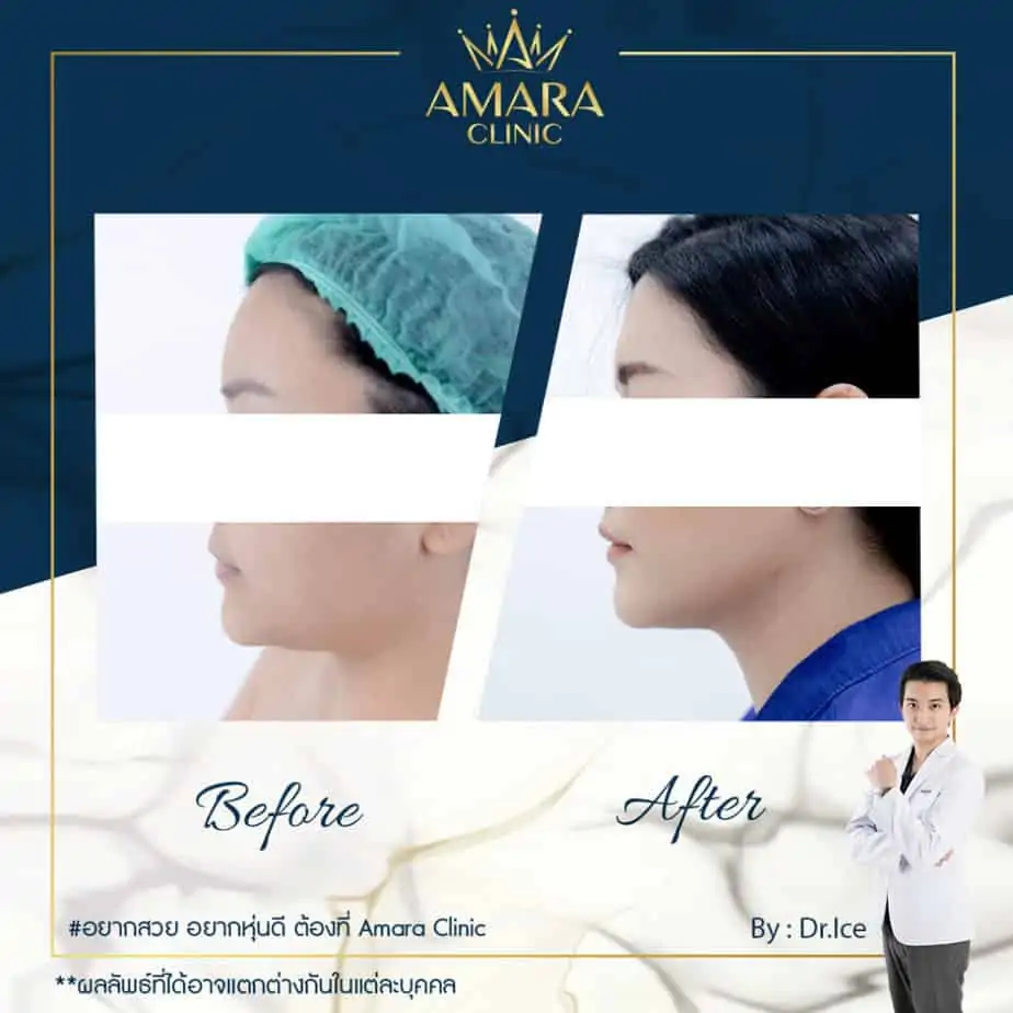 ดูดไขมัน เติมไขมัน Amara Liposuction Center (เอมาร่า คลินิก) โดยแพทย์ผู้มีประสบการณ์
