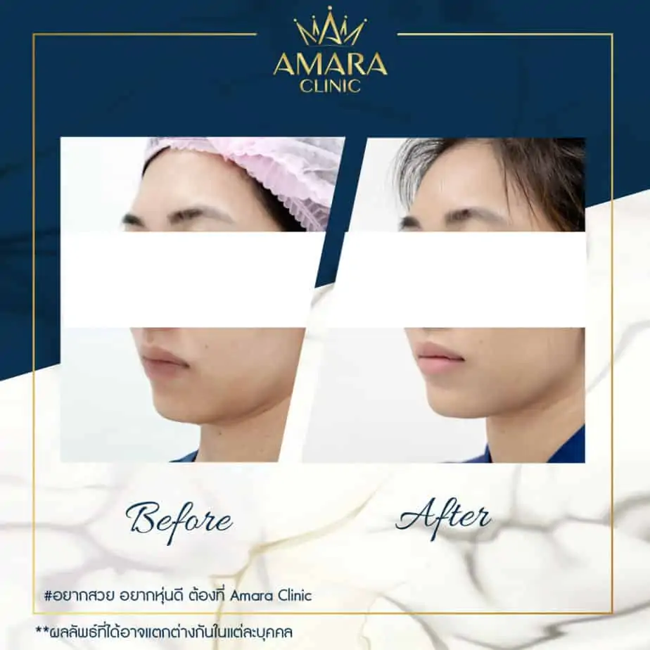 ดูดไขมัน เติมไขมัน Amara Liposuction Center (เอมาร่า คลินิก) โดยแพทย์ผู้มีประสบการณ์