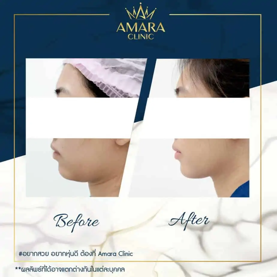 ดูดไขมัน เติมไขมัน Amara Liposuction Center (เอมาร่า คลินิก) โดยแพทย์ผู้มีประสบการณ์