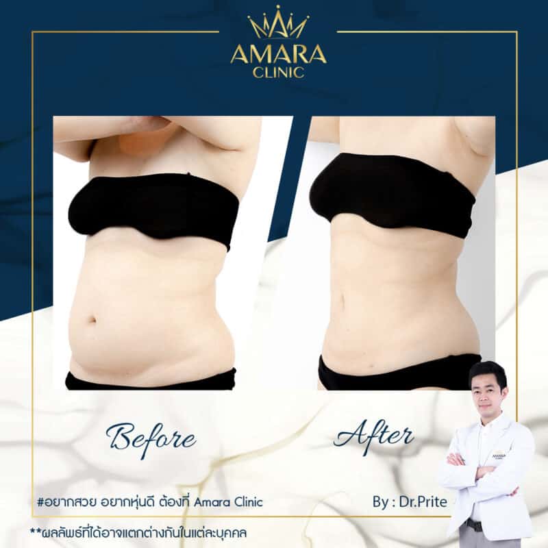BA liposuction - amara