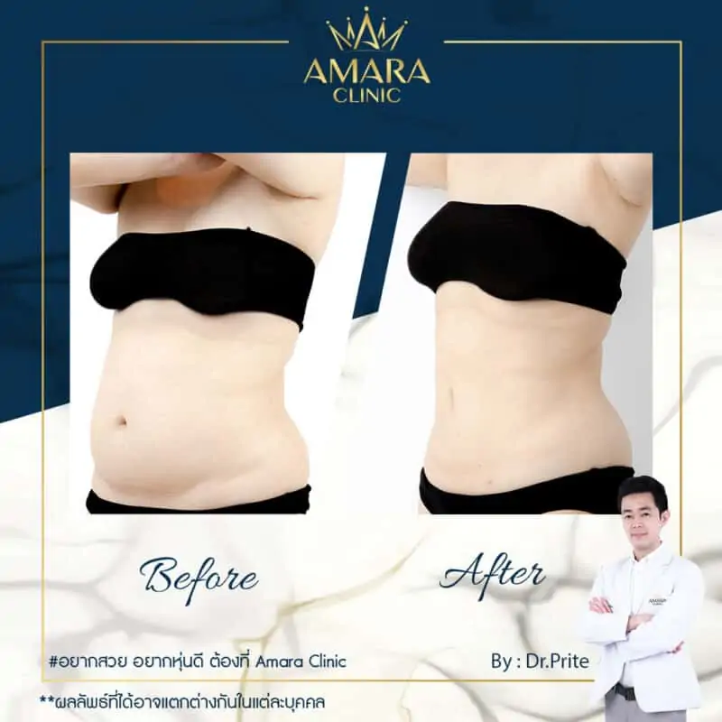 BA liposuction - amara