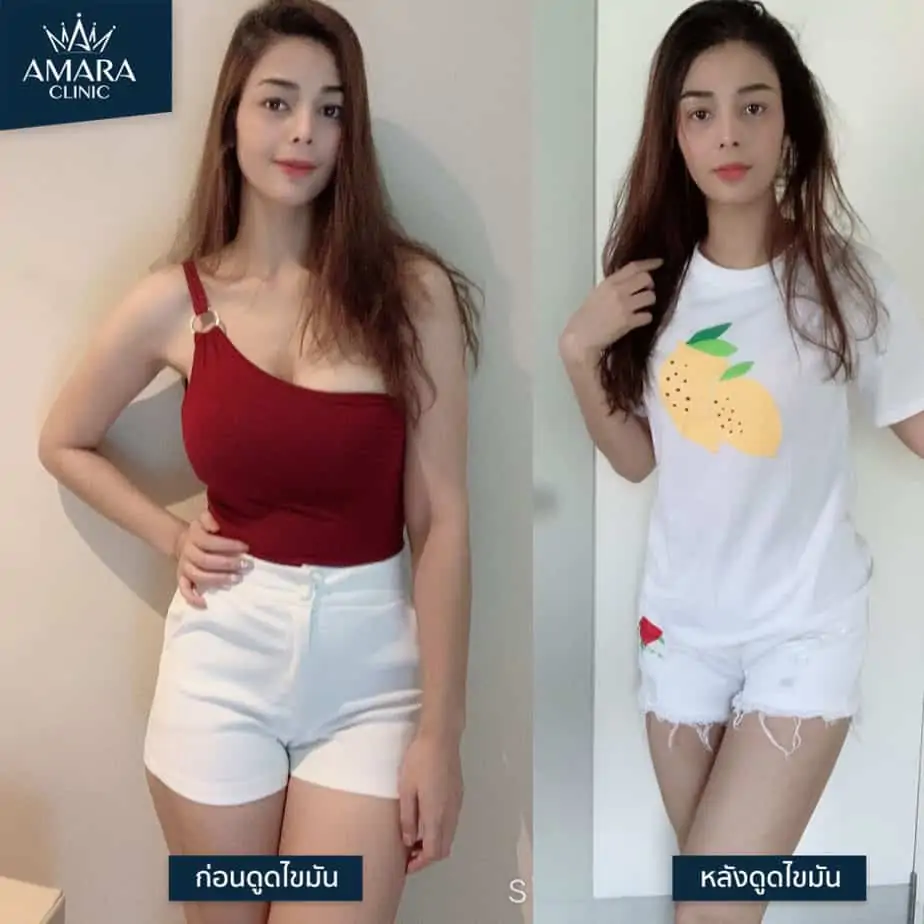 ดูดไขมัน เติมไขมัน Amara Liposuction Center (เอมาร่า คลินิก) โดยแพทย์ผู้มีประสบการณ์