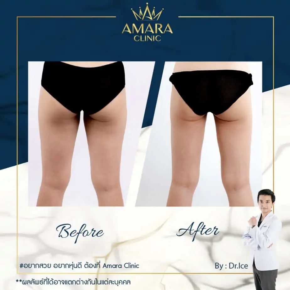 ดูดไขมัน เติมไขมัน Amara Liposuction Center (เอมาร่า คลินิก) โดยแพทย์ผู้มีประสบการณ์