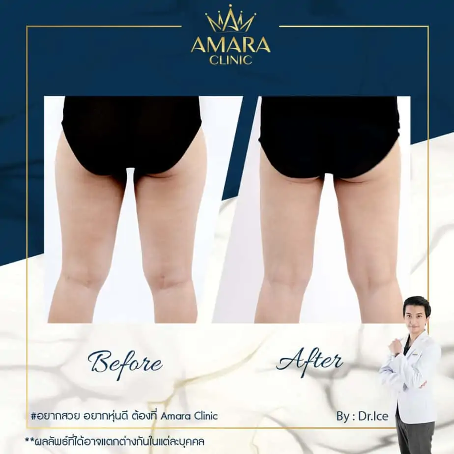 ดูดไขมัน เติมไขมัน Amara Liposuction Center (เอมาร่า คลินิก) โดยแพทย์ผู้มีประสบการณ์
