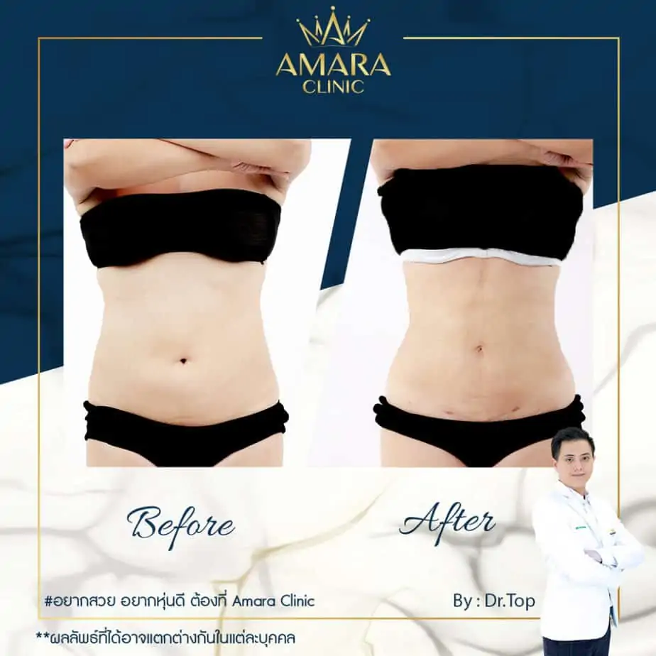 ดูดไขมัน เติมไขมัน Amara Liposuction Center (เอมาร่า คลินิก) โดยแพทย์ผู้มีประสบการณ์
