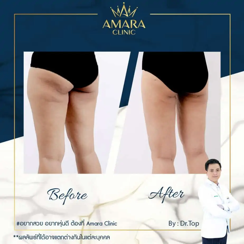 ดูดไขมัน เติมไขมัน Amara Liposuction Center (เอมาร่า คลินิก) โดยแพทย์ผู้มีประสบการณ์