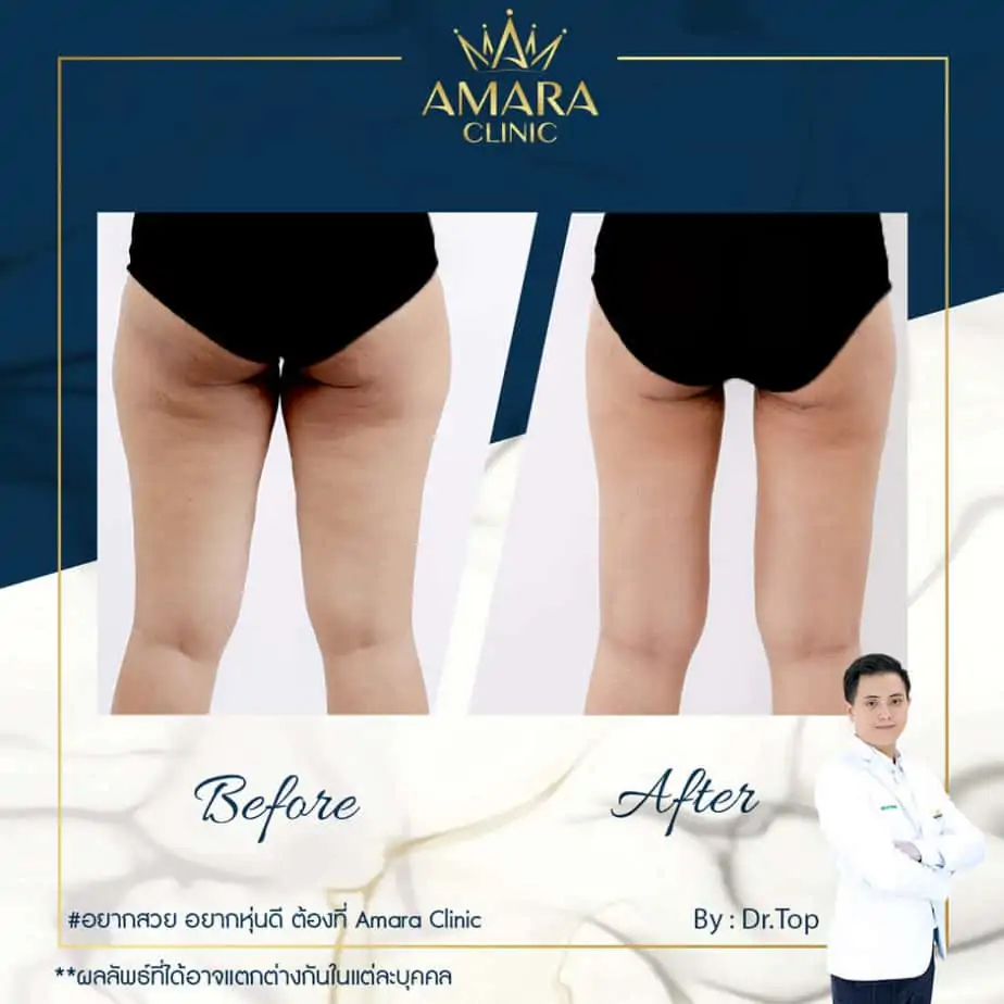 ดูดไขมัน เติมไขมัน Amara Liposuction Center (เอมาร่า คลินิก) โดยแพทย์ผู้มีประสบการณ์