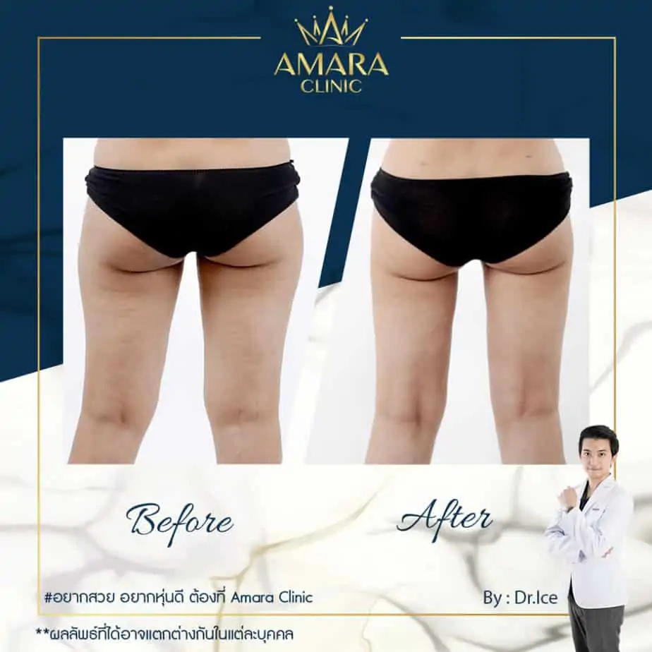 ดูดไขมัน เติมไขมัน Amara Liposuction Center (เอมาร่า คลินิก) โดยแพทย์ผู้มีประสบการณ์