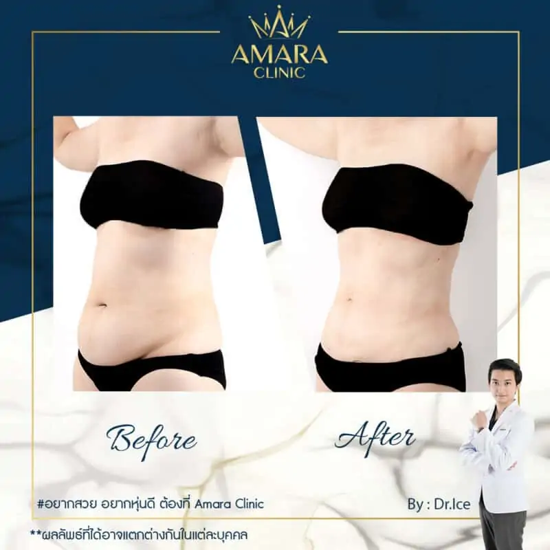 BA liposuction