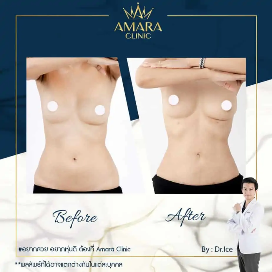 ดูดไขมัน เติมไขมัน Amara Liposuction Center (เอมาร่า คลินิก) โดยแพทย์ผู้มีประสบการณ์