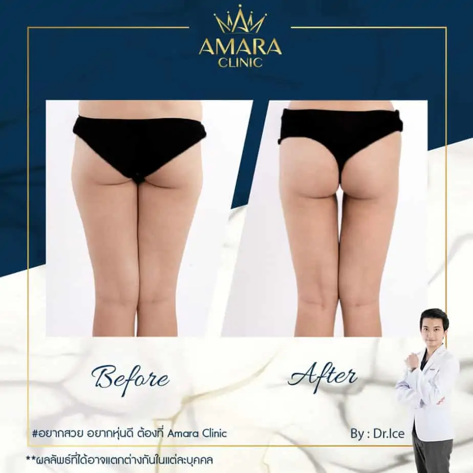 ดูดไขมัน เติมไขมัน Amara Liposuction Center (เอมาร่า คลินิก) โดยแพทย์ผู้มีประสบการณ์