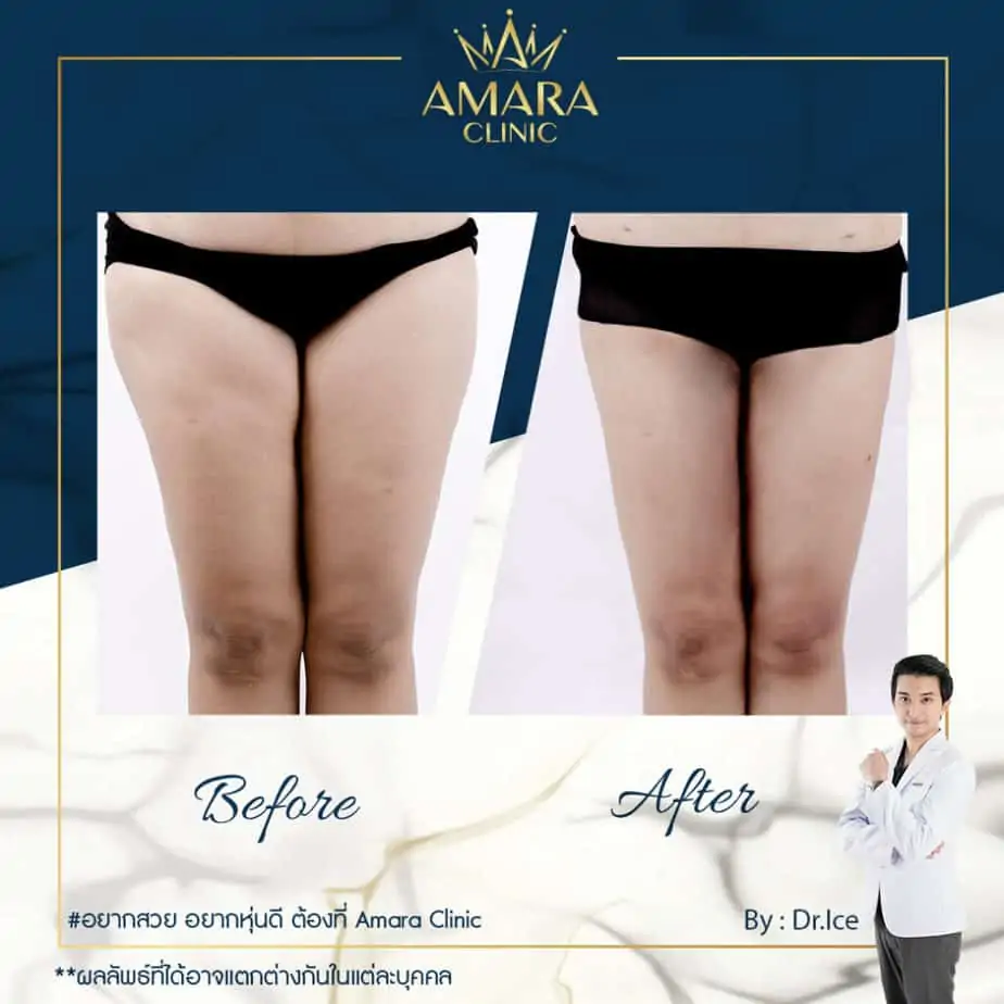 ดูดไขมัน เติมไขมัน Amara Liposuction Center (เอมาร่า คลินิก) โดยแพทย์ผู้มีประสบการณ์