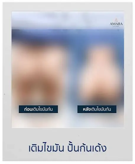 ดูดไขมัน เติมไขมัน Amara Liposuction Center (เอมาร่า คลินิก) โดยแพทย์ผู้มีประสบการณ์