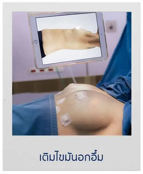 ดูดไขมัน เติมไขมัน Amara Liposuction Center (เอมาร่า คลินิก) โดยแพทย์ผู้มีประสบการณ์