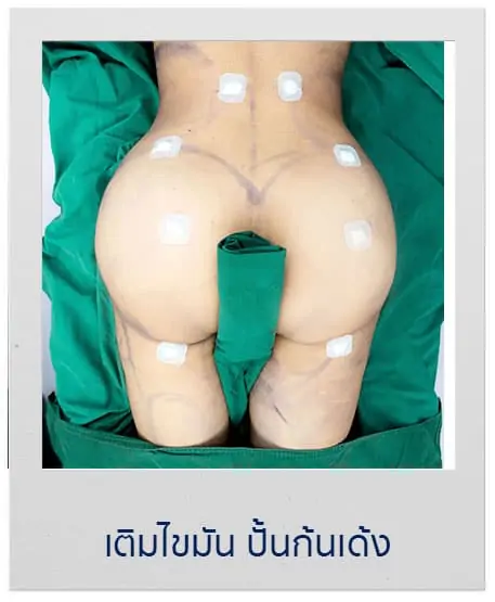 ดูดไขมัน เติมไขมัน Amara Liposuction Center (เอมาร่า คลินิก) โดยแพทย์ผู้มีประสบการณ์