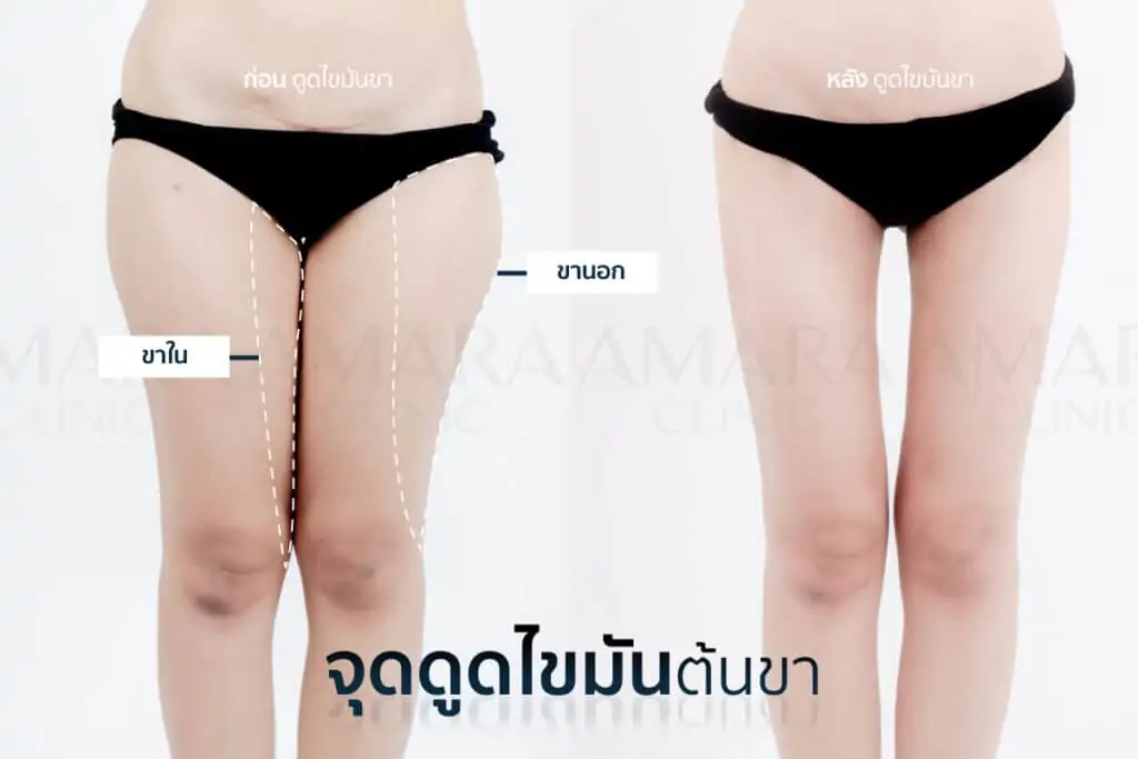 ดูดไขมัน เติมไขมัน Amara Liposuction Center (เอมาร่า คลินิก) โดยแพทย์ผู้มีประสบการณ์
