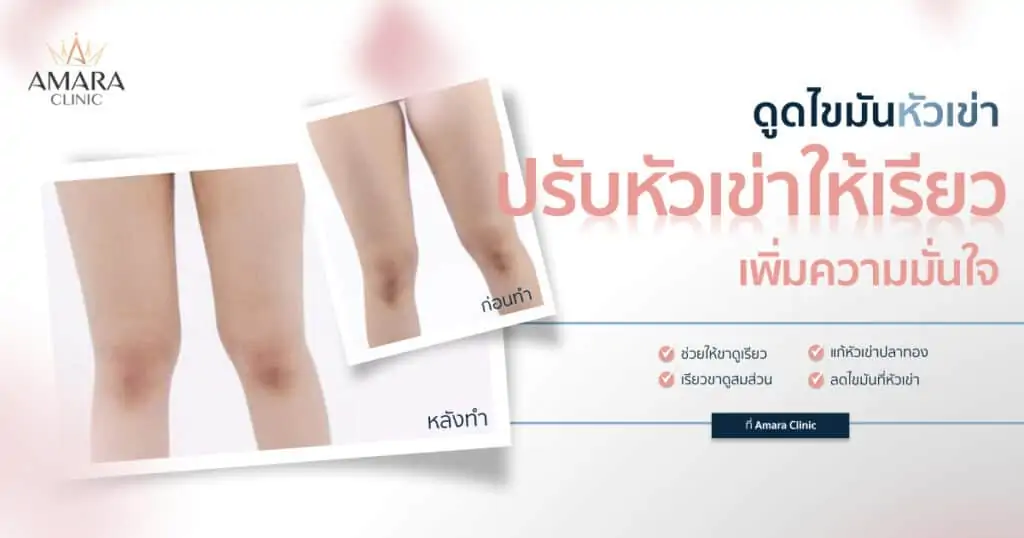 ดูดไขมัน เติมไขมัน Amara Liposuction Center (เอมาร่า คลินิก) โดยแพทย์ผู้มีประสบการณ์