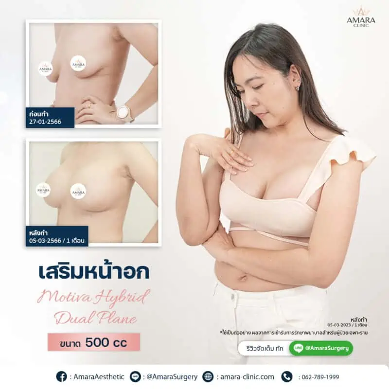 รีวิว เสริมหน้าอก