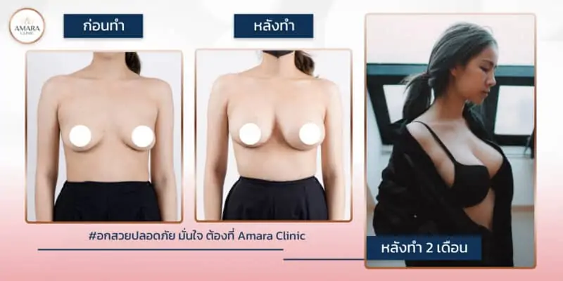 รีวิวเสริมหน้าอก