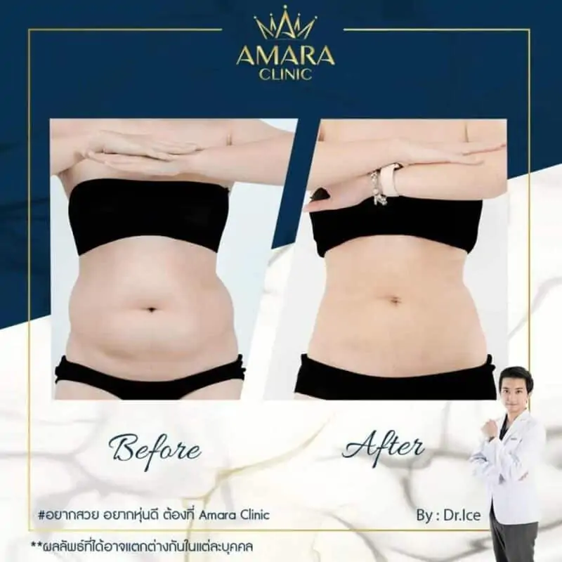 BA liposuction amara