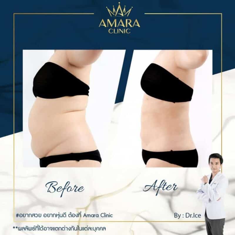 review liposuction in thailand - bkk